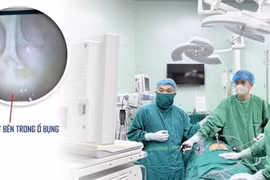 Đau hạ vị kéo dài, người phụ nữ vỡ áp xe phần phụ, mủ tràn ổ bụng