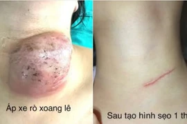 U nang vùng cổ rò xoang lê thường gặp ở trẻ, dễ tái phát