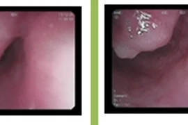 Nội soi tiêu hóa vì nuốt nghẹn, phát hiện khối u thực quản kích thước lớn