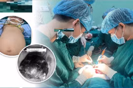 Phẫu thuật bóc tách khối u bằng 1/3 cân nặng, bảo tồn nhiều cơ quan cho trẻ
