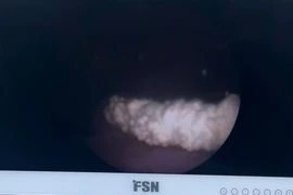 Bỏ quên ống sonde JJ 3 năm, vô tình trở thành “giá đỡ” cho sỏi bám