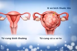 28 tuổi, chưa lập gia đình nhưng phát hiện khối u tử cung hơn 30cm