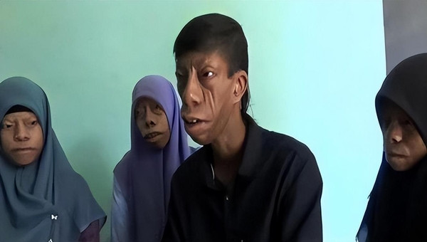 Người 'mặt ngựa' như bị nguyền rủa và câu chuyện đổi đời ngoạn mục - Hình 12 Nguoi 'mat ngua' nhu bi nguyen rua va cau chuyen doi doi ngoan muc-Hinh-12