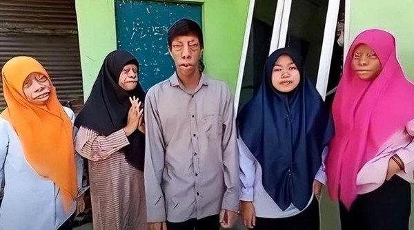 Người 'mặt ngựa' như bị nguyền rủa và câu chuyện đổi đời ngoạn mục - Hình 8 Nguoi 'mat ngua' nhu bi nguyen rua va cau chuyen doi doi ngoan muc-Hinh-8