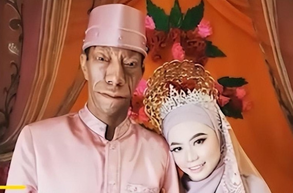 Người 'mặt ngựa' như bị nguyền rủa và câu chuyện đổi đời ngoạn mục - Hình 10 Nguoi 'mat ngua' nhu bi nguyen rua va cau chuyen doi doi ngoan muc-Hinh-10