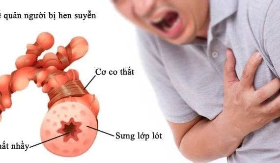 Kiểm soát bệnh hen phế quản để tránh biến chứng nguy hiểm