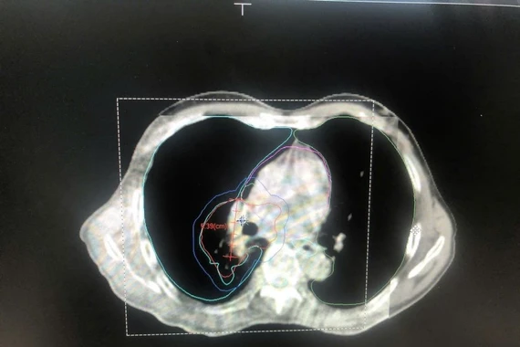 Điều trị ung thư phổi bằng phương pháp kết hợp hoá xạ trị mang lại hy vọng
