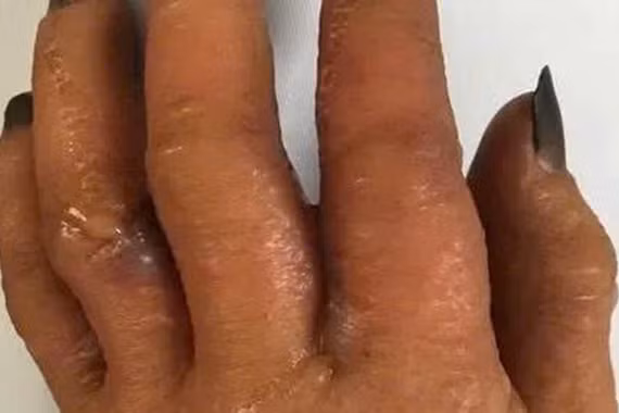 Tự nhuộm tóc tại nhà không đeo găng tay, người đàn ông phải nhập viện 