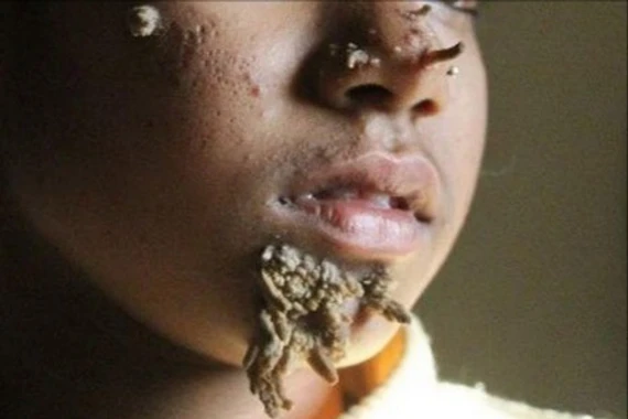 Việt Nam ghi nhận ca thứ hai mắc hội chứng 'người cây', bệnh nguy hiểm sao?