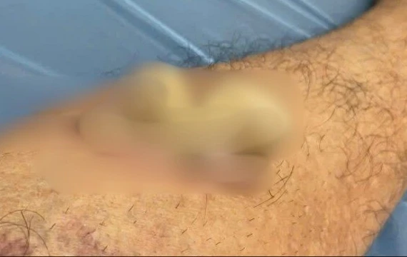 Điều trị u nhú tế bào gai sừng hóa bằng laser tại Đồng Nai