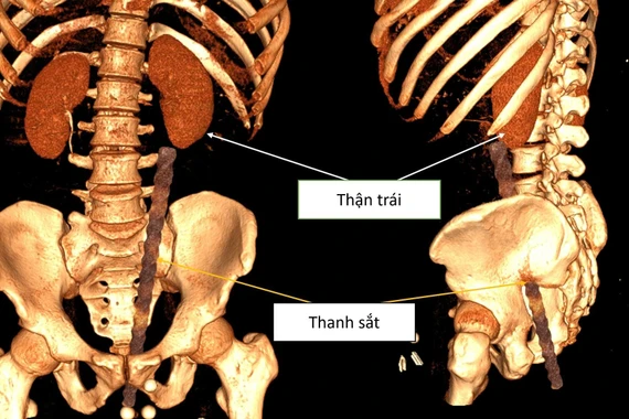 Phẫu thuật cấp cứu thành công cho nam giới bị dị vật xuyên bụng do tai nạn