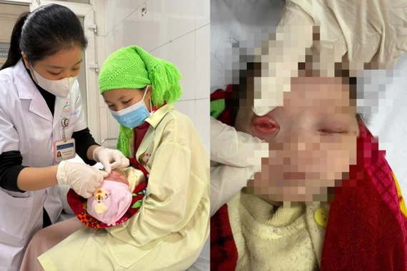 Trẻ sơ sinh bị viêm kết mạc do cha mẹ tự ý dùng biện pháp dân gian