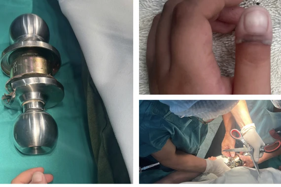 Bé 5 tuổi mắc kẹt ngón tay vào ổ khóa, thoát hiểm ngoạn mục