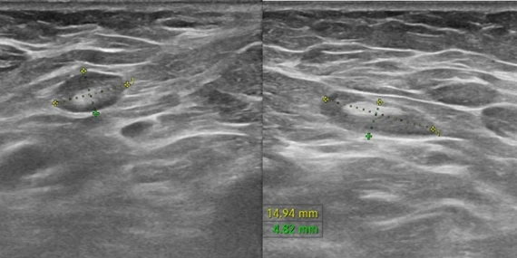 Phát hiện sớm ung thư vú ở người cao tuổi nhờ xét nghiệm giải phẫu bệnh
