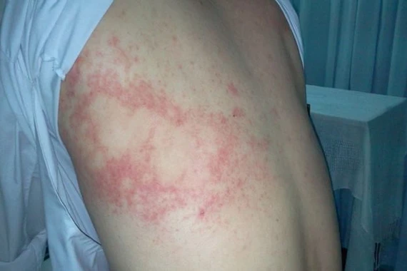 Bệnh giun sán gia tăng tại Khánh Hòa, 291 ca dương tính trong 14 ngày