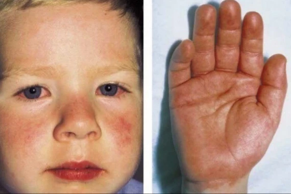 Nhận biết dấu hiệu bệnh Kawasaki