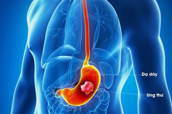 Ca phẫu thuật cho bệnh nhân ung thư dạ dày kết hợp 'sửa' dị tật bẩm sinh
