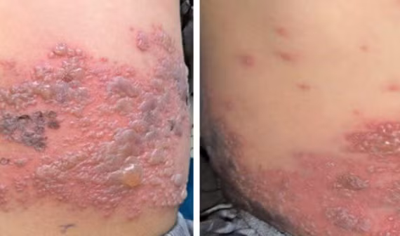 Bé trai 4 tuổi mắc cùng lúc Zona và Thủy đậu, trường hợp hiếm gặp trong y văn