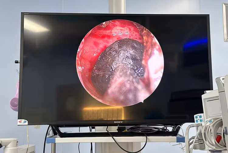 Hình ảnh khối nấm trong xoang bướm bệnh nhân.