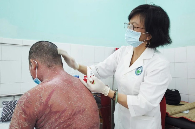 Bệnh nhân bị đỏ da toàn thân sau khi sử dụng thuốc trôi nỗi để điều trị vảy nến.