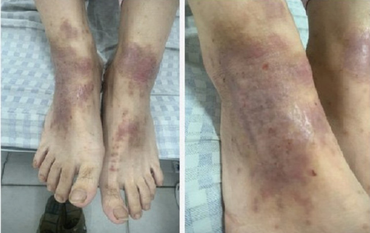 Hình ảnh người bệnh sau khi được các bác sĩ, điều dưỡng tại khoa Da liễu chăm sóc, điều trị.