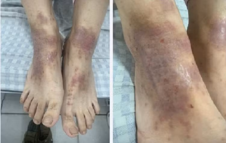 Hình ảnh người bệnh sau khi được các bác sĩ, điều dưỡng tại khoa Da liễu chăm sóc, điều trị.