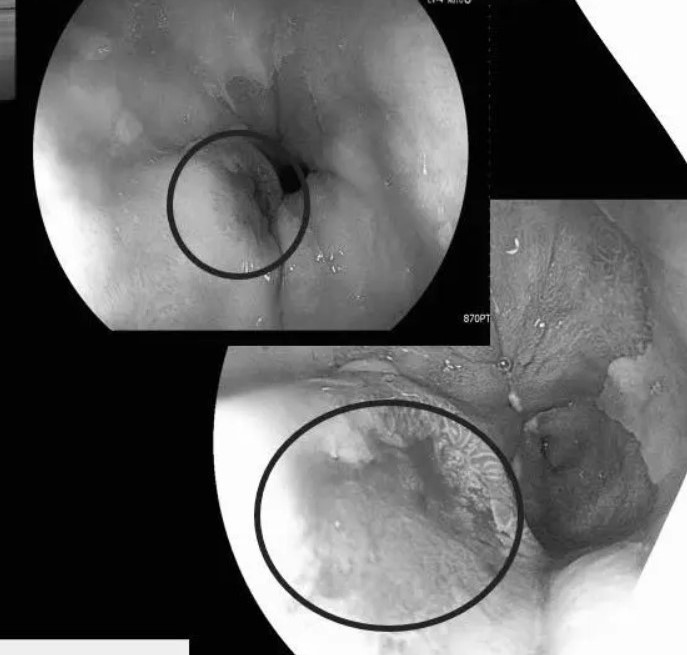 Nếu được tầm soát và phát hiện ở giai đoạn sớm thì tỉ lệ điều trị ung thư thành công tốt hơn rất nhiều.