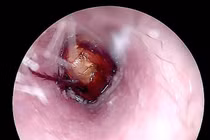 Côn trùng chui vào tai bệnh nhân ở Quảng Trị được gắp thành công