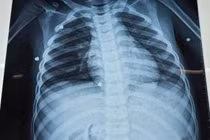 Cháu bé 6 tuổi ở Quảng Trị bị đa chấn thương do nghịch súng hơi 