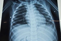 Cháu bé 6 tuổi ở Quảng Trị bị đa chấn thương do nghịch súng hơi 