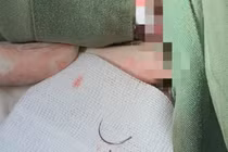 Gắp kim khâu nằm trong tầng sinh môn người phụ nữ suốt 11 năm