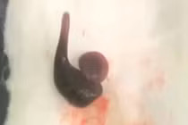 Con đỉa dài 4 cm sống cả tuần trong mũi người đàn ông