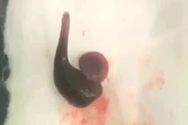 Con đỉa dài 4 cm sống cả tuần trong mũi người đàn ông