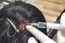 Nam sinh ở Quảng Trị bị móc câu 3 tiêu cắm sâu vào đỉnh đầu