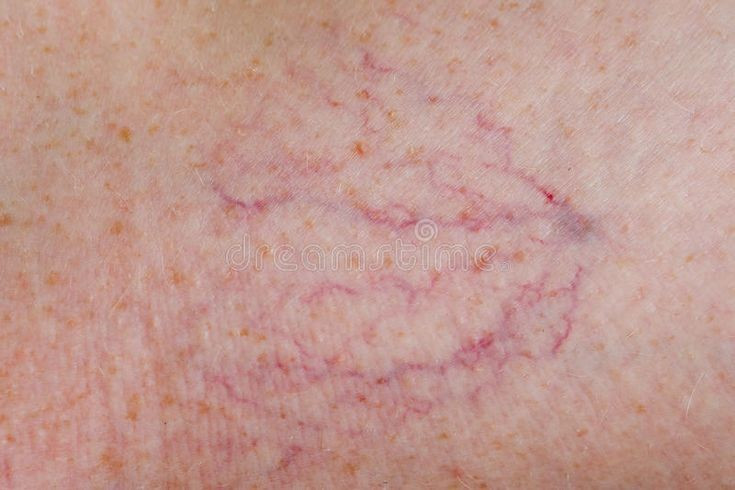 “Kỹ sư đào hầm” đáng sợ. Con cái của loài ghẻ có khả năng đào những đường hầm ngoằn ngoèo dưới da để đẻ trứng. Mỗi ngày, chúng có thể đẻ 2–3 trứng, khiến số lượng ký sinh tăng nhanh nếu không được điều trị. Ảnh: Pinterest.