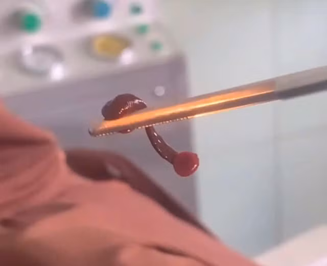 Gắp thành công con vắt dài 3 cm sống trong mũi người đàn ông Gap thanh cong con vat dai 3 cm song trong mui nguoi dan ong