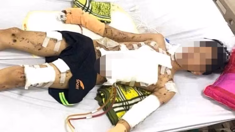 Tự chế pháo ở nhà, nam sinh bị giập nát hai bàn tay Tu che phao o nha, nam sinh bi giap nat hai ban tay