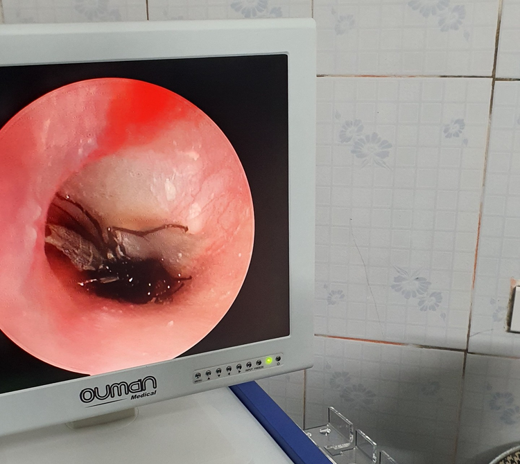 Con gián được phát hiện trong tai cháu bé. Ảnh: Sức khỏe đời sống Con gián được phát hiện trong tai cháu bé. Ảnh: Sức khỏe đời sống