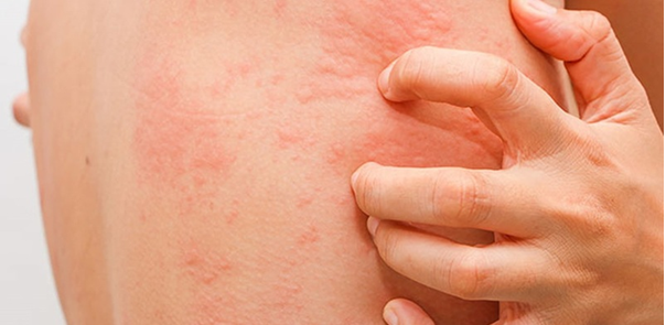 Hình ảnh nổi mề đay khá phổ biến