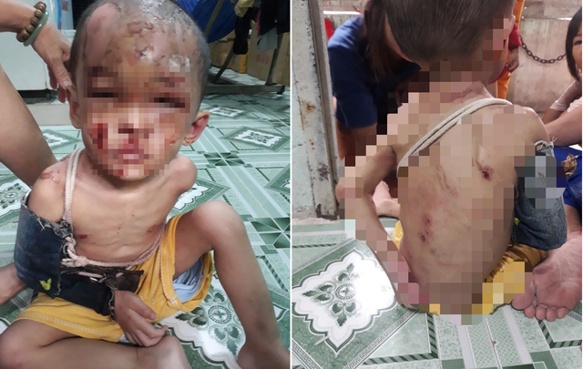 Bé trai khi được phát hiện những vết thương trên người. Ảnh: Sức khỏe và đời sống.