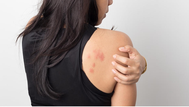 Đau sau zona tái phát nhiều lần ảnh hưởng rất lớn đến cuộc sống người mắc