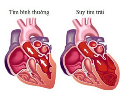 Suy tim trái là thể thường gặp nhất và là hậu quả cuối cùng của nhiều bệnh lý tim mạch Suy tim trái là thể thường gặp nhất và là hậu quả cuối cùng của nhiều bệnh lý tim mạch