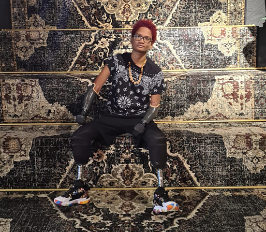 Tatiana Timon phải cắt cụt tứ chi sau khi bị sốt rét vì muỗi đốt. Ảnh The Sun