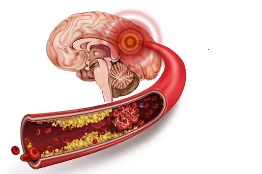 Cục máu đông trong não là nguyên nhân hàng đầu gây đột quỵ