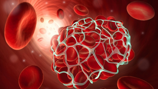 Nắng nóng làm tăng nguy cơ cô đặc máu gây đột quỵ Nắng nóng làm tăng nguy cơ cô đặc máu gây đột quỵ