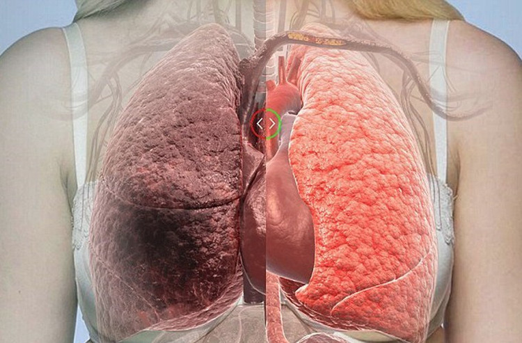 Không hút thuốc lá có bị ung thư phổi không? ảnh 2