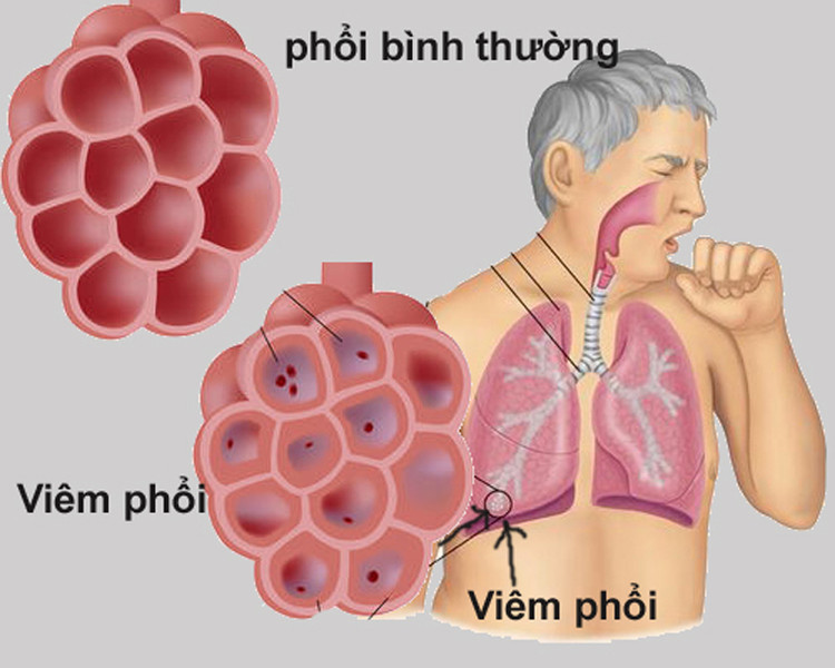 Không hút thuốc lá có bị ung thư phổi không? ảnh 8