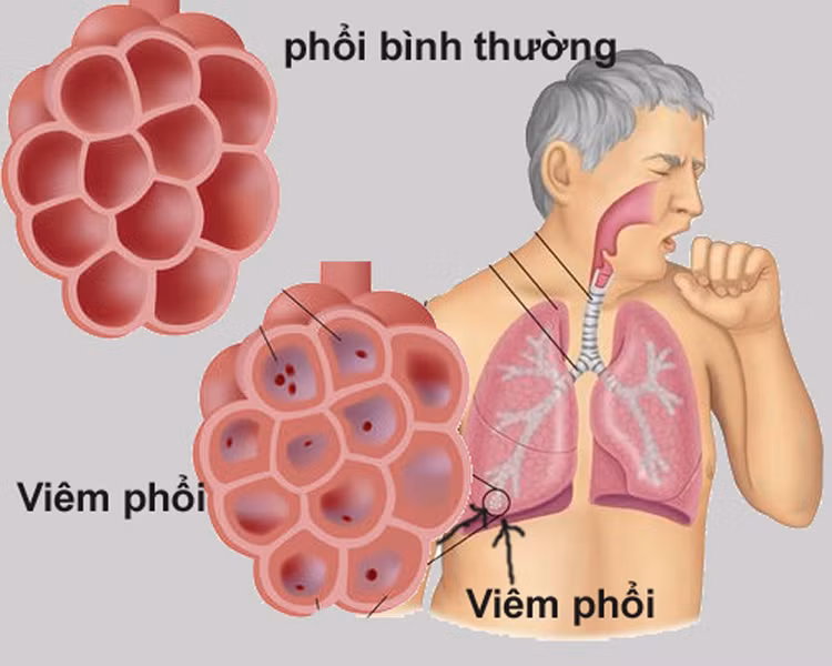 Không hút thuốc lá có bị ung thư phổi không? ảnh 8