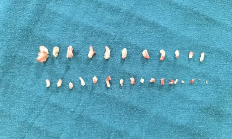 28 chiếc răng lớn nhỏ được lấy ra khỏi khối u. Ảnh: Tạp chí điện tử Người Đưa Tin