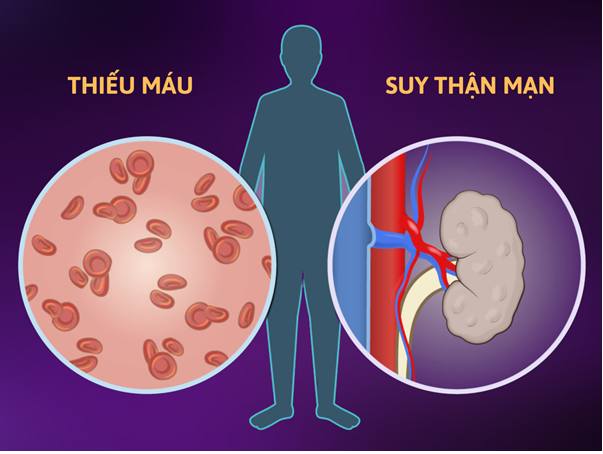 Thiếu máu là biến chứng thường gặp ở người bị suy thận